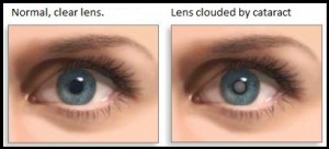 Cataract clouded lens